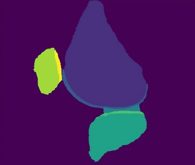 核磁快速AI重建